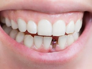 Mouth with dental implant