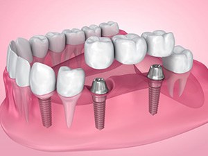 Illustration of dental implants in gum tissue with bridge and crown