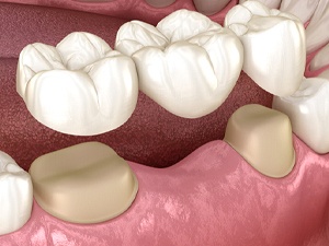 Image of a dental bridge on the lower teeth
