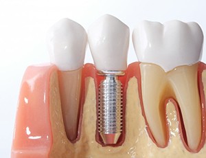 an example of a dental implant