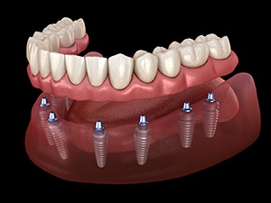 A 3D illustration of a denture being set over multiple dental implants